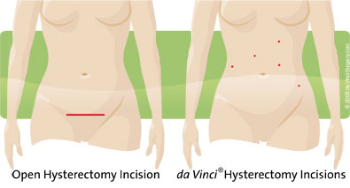 Incision Section comparison graphic