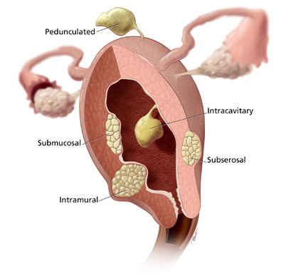 Graphic of uterus with fibroids